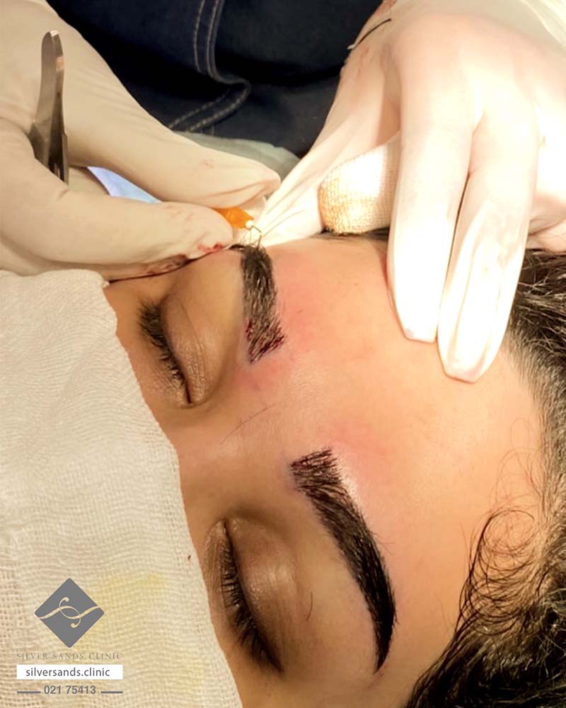 فیلم کاشت ابرو از صفر تا صد + قبل از کاشت ابرو چه داروهایی نباید خورد