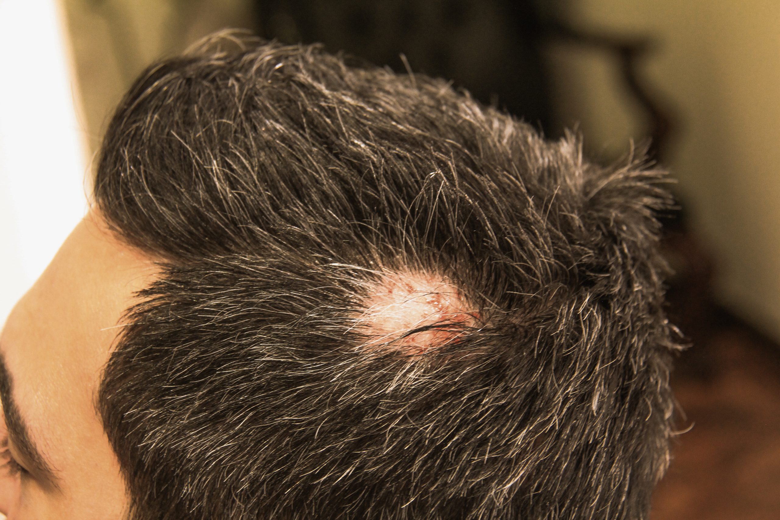 ریزش موی سکه ای چیست؟ علل و راه های درمان