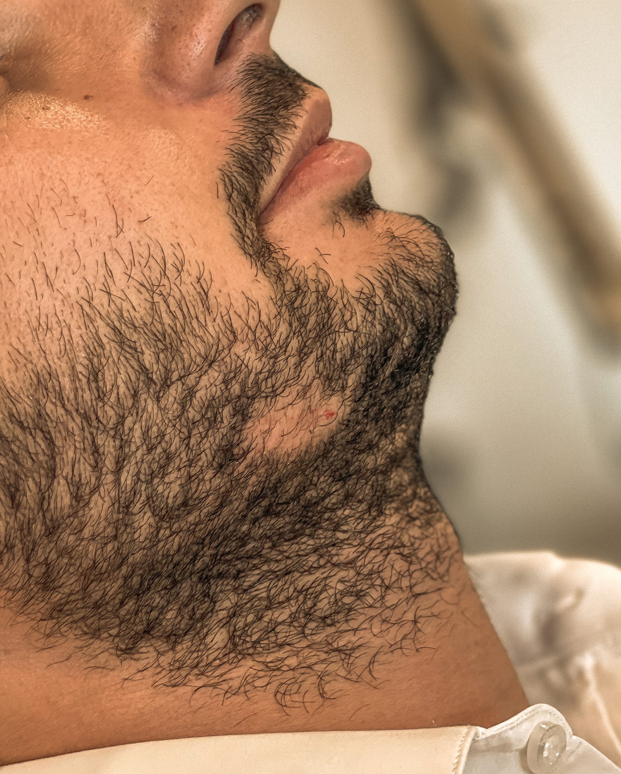 ریزش موی سکه ای چیست؟ علل و راه های درمان